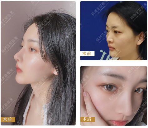 杭州做鼻子最好的医生是谁