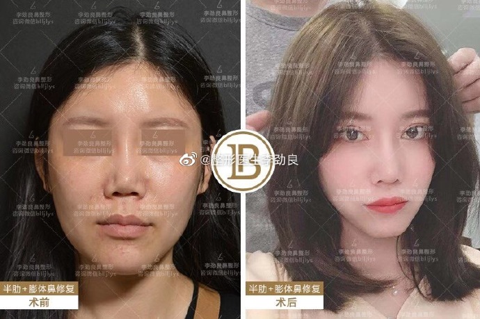 李劲良刘彦军哪个做鼻子好