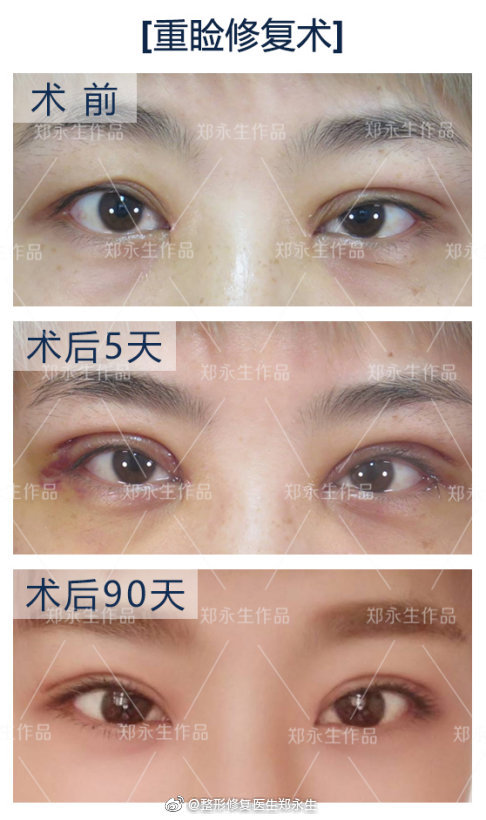 郑永生和李斌斌眼修复谁好