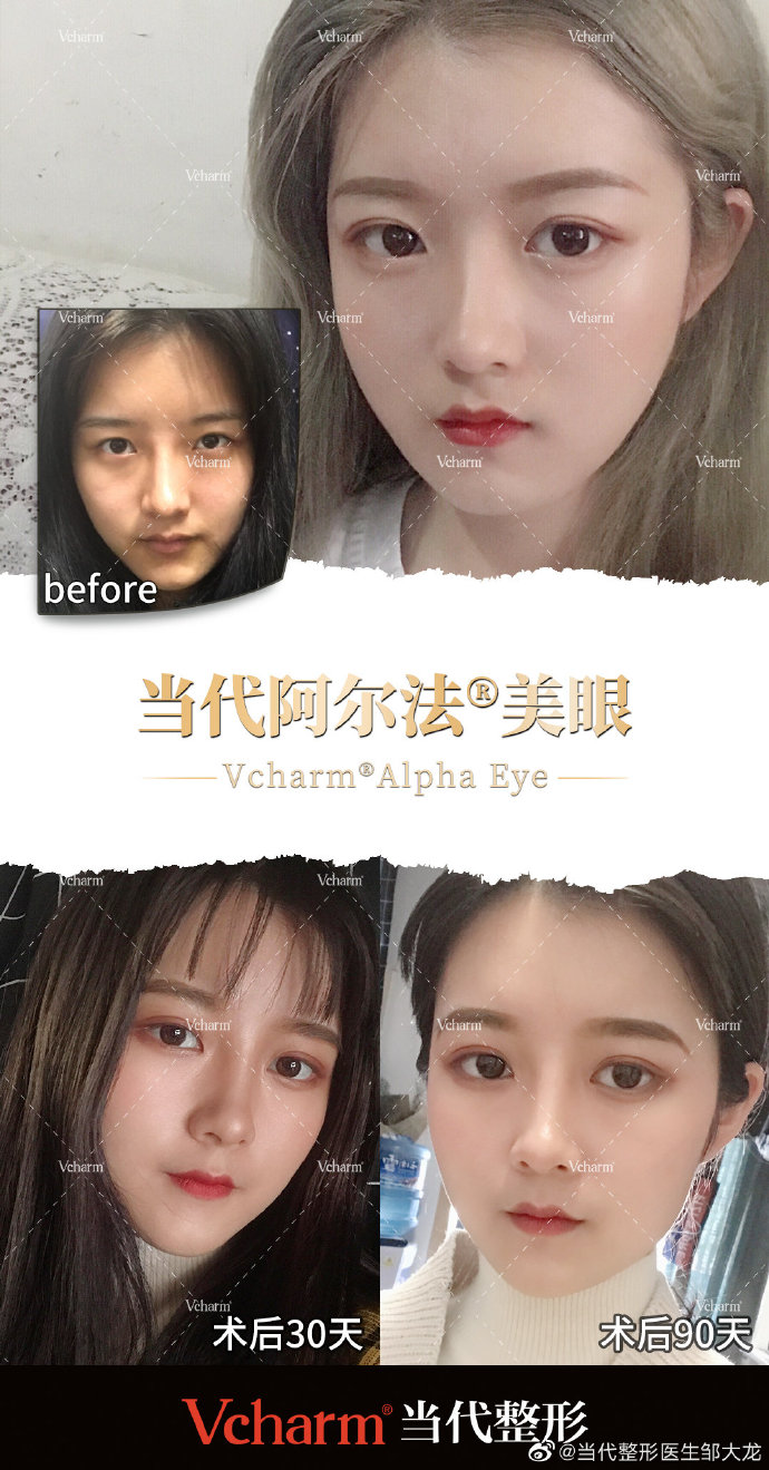 重庆邹大龙双眼皮怎么样