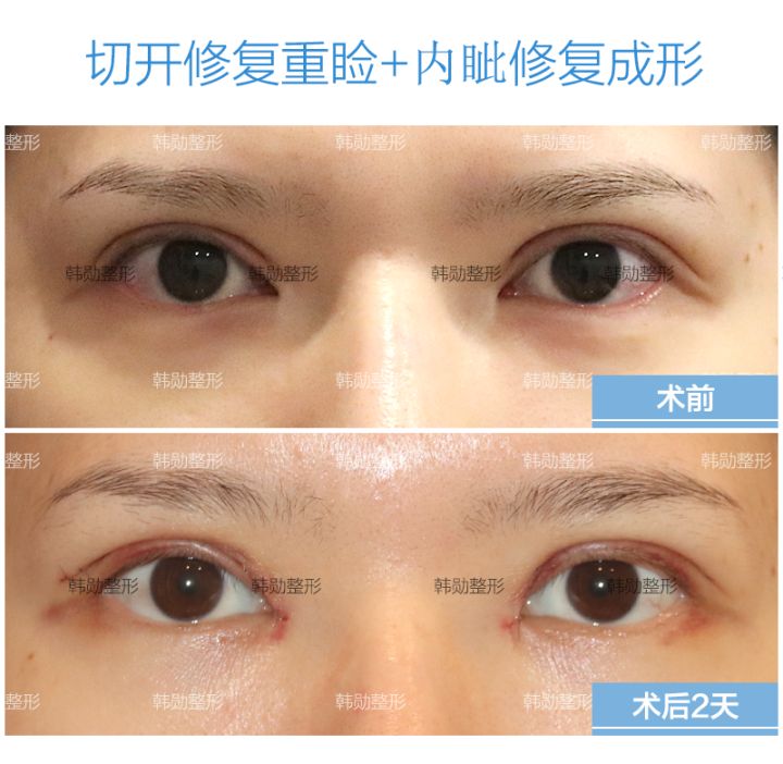 北京韩勋双眼皮修复手术技术怎么样