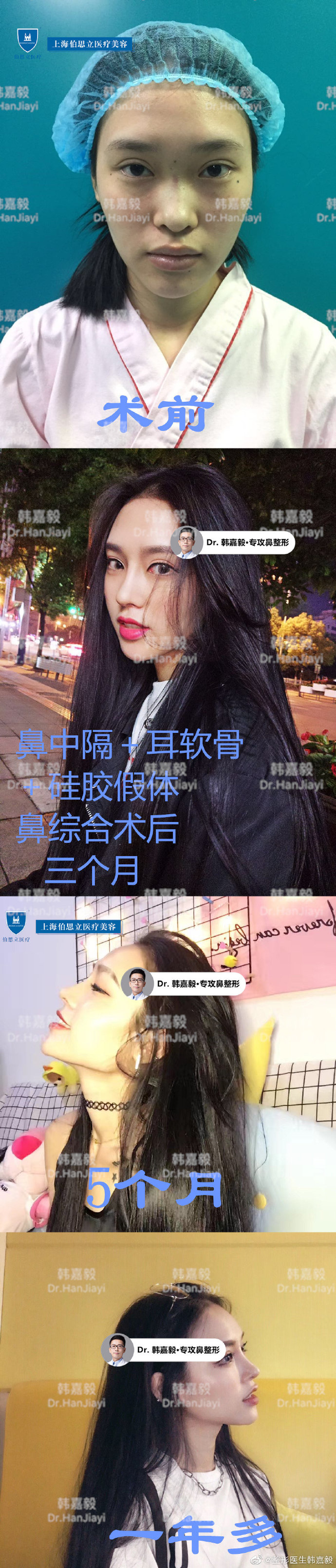 上海韩嘉毅肋骨鼻做得好吗