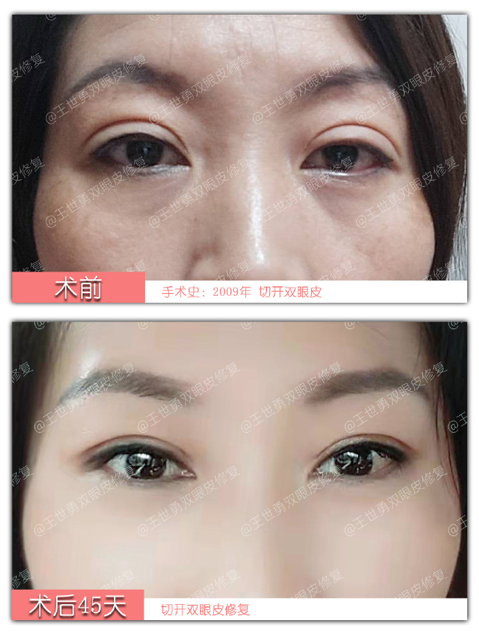 北京双眼皮修复王世勇和靳小雷谁厉害？