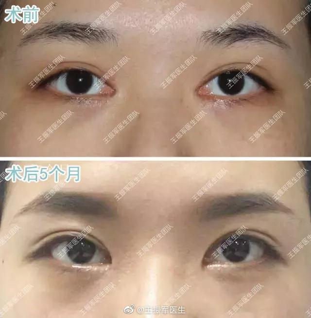 王振军和朱慧敏哪个双眼皮修复技术好？