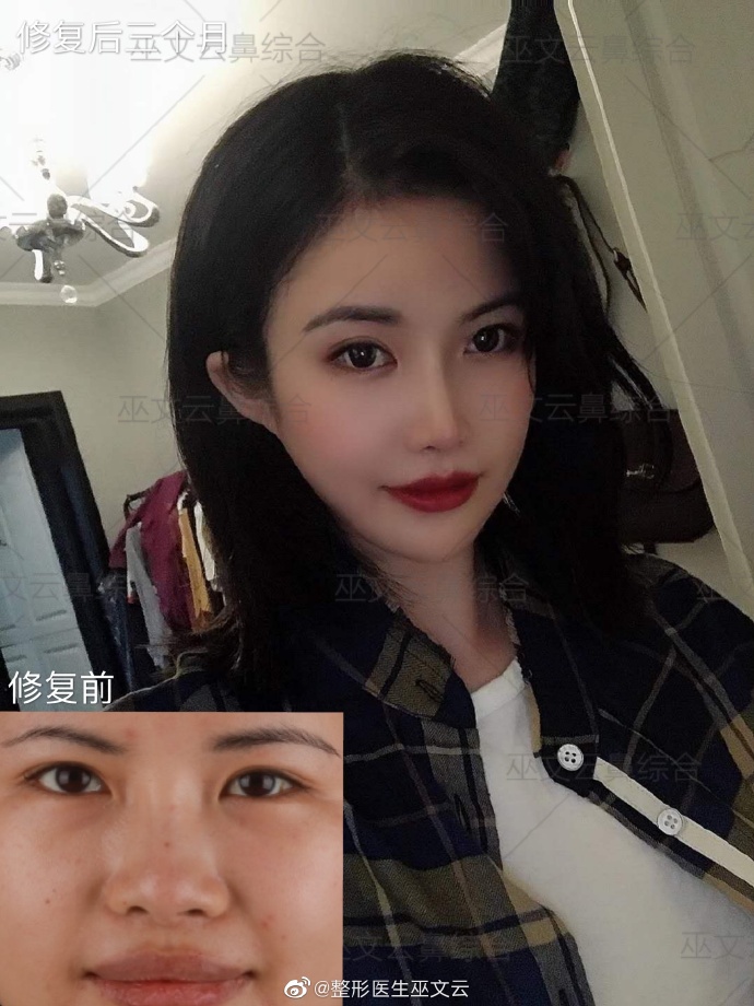 巫文云和王会勇谁做鼻修复好