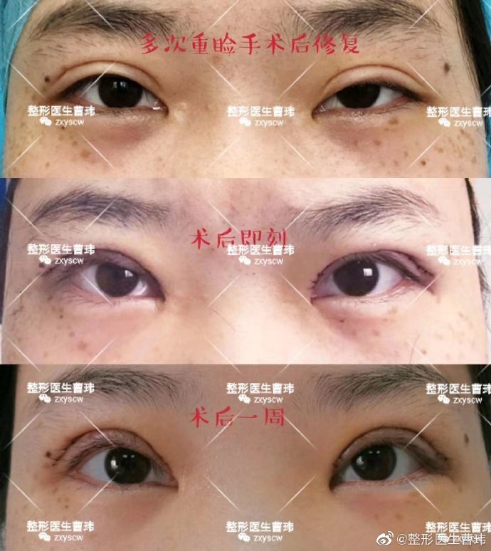 武汉同济双眼皮修复曹玮技术怎么样