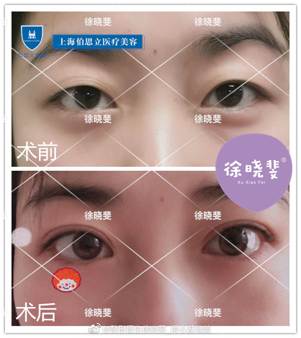 上海割双眼皮徐晓斐和杨亚益谁做的好