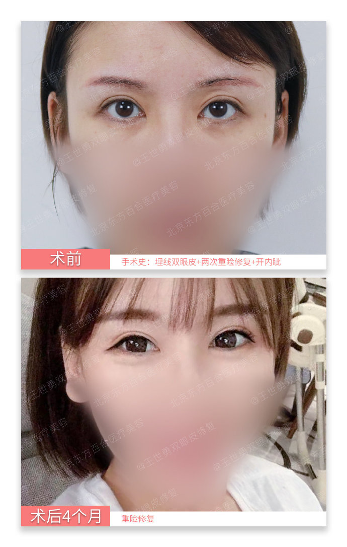 王世勇和郑永生哪个做双眼皮修复好？