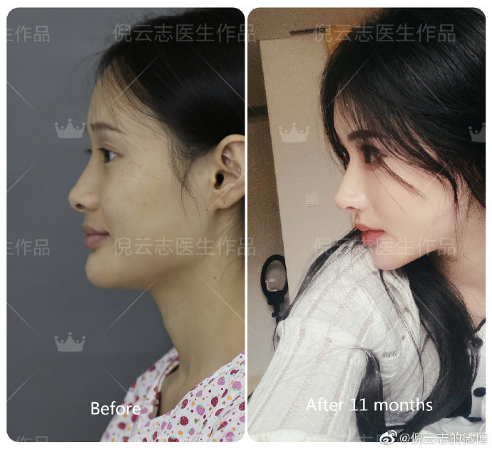 倪云志和徐航哪个隆鼻技术好