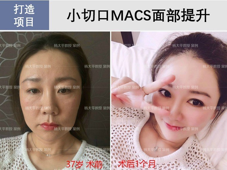 杨大平和李晓东做面部提升谁做的好