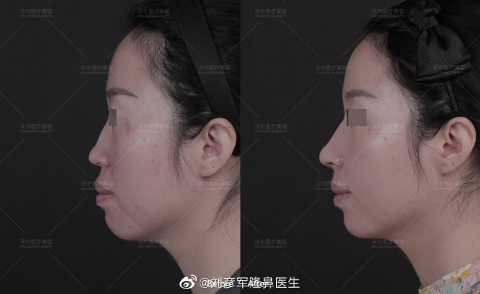 刘彦军和李劲良谁做的鼻子好