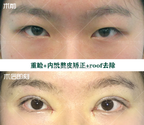南京省中医哪个医生做双眼皮好
