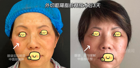 上海九院高博闻做祛眼袋技术怎么样？高博闻去眼袋预约电话咨询