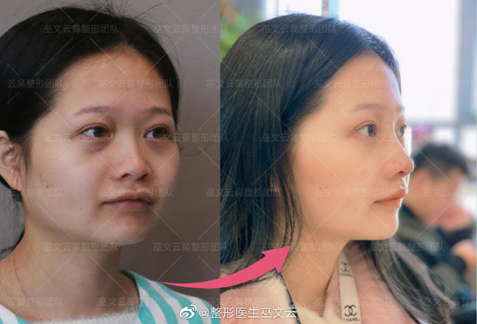 北京鼻修复巫文云李劲良哪个修复更熟练？