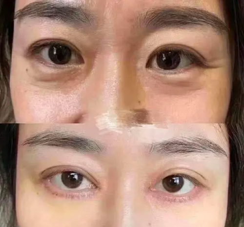 上海九院祛眼袋哪个医生好，高博闻、许志成、刘菲、金云波哪个最好？