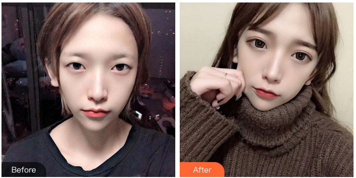 郑州双眼皮医生哪个医生好