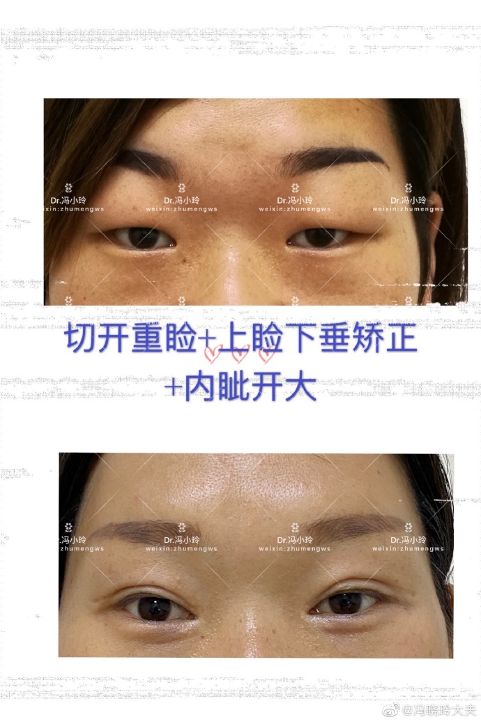 武汉修复双眼皮冯晓玲技术怎么样