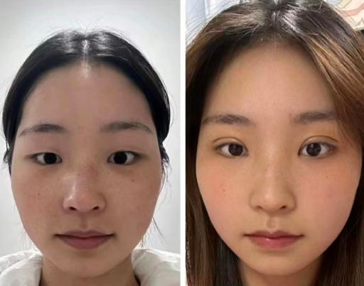 西安肖潮医生双眼皮做的怎么样？肖潮做双眼皮技术好吗？