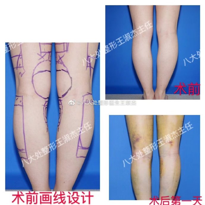 北京八大处吸脂王淑杰和顾云鹏哪个好？