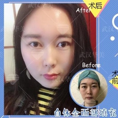 武汉刘光伟面部填充和自体脂肪丰胸贵不贵？效果好不好？