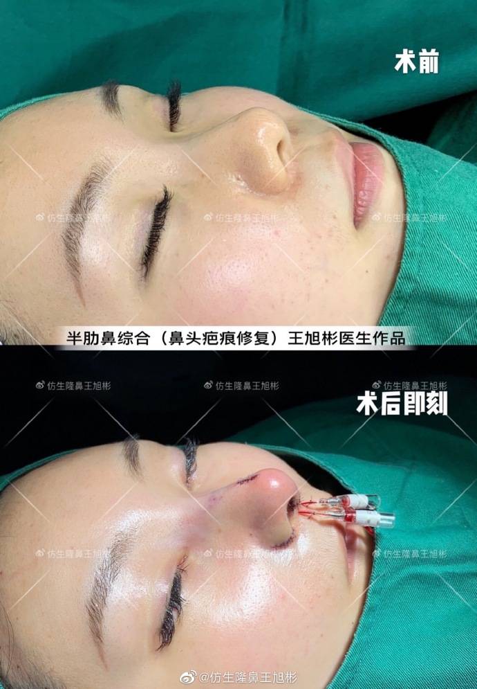 广州王旭彬做鼻子怎么样
