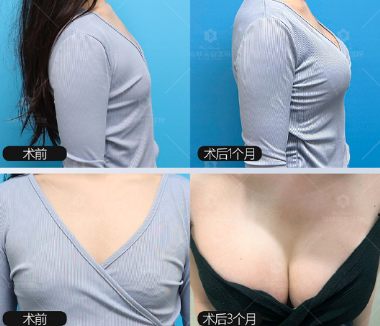 福州隆胸专家林沸腾内窥镜隆胸怎么样？