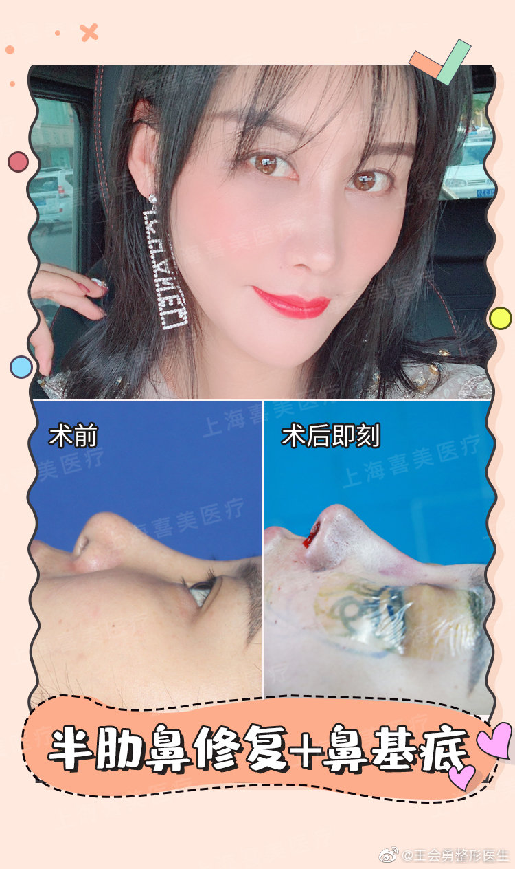 上海最有名气的鼻王是哪位医生？