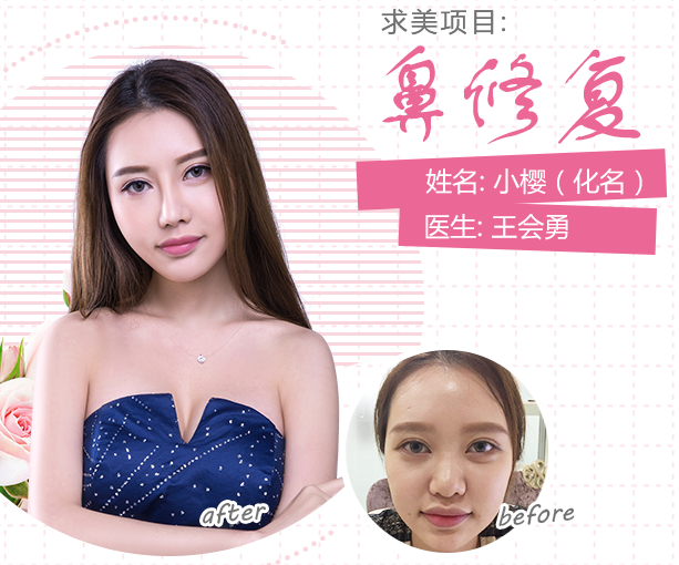 上海王会勇跟张毅哪个做鼻子好？