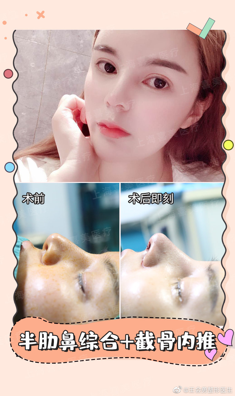 上海王会勇与韩嘉毅哪个做鼻综合效果好？