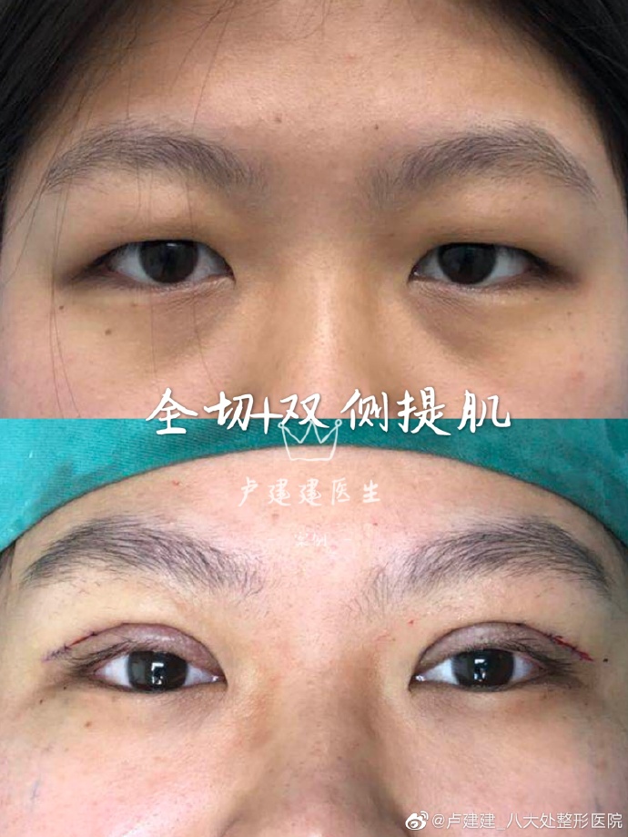 卢建建和王太玲哪个做双眼皮&眼修复比较好？