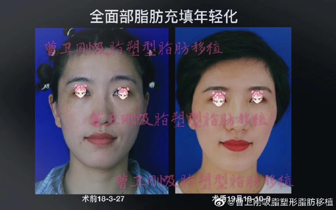 上海九院脂肪填充全脸哪个医生好？
