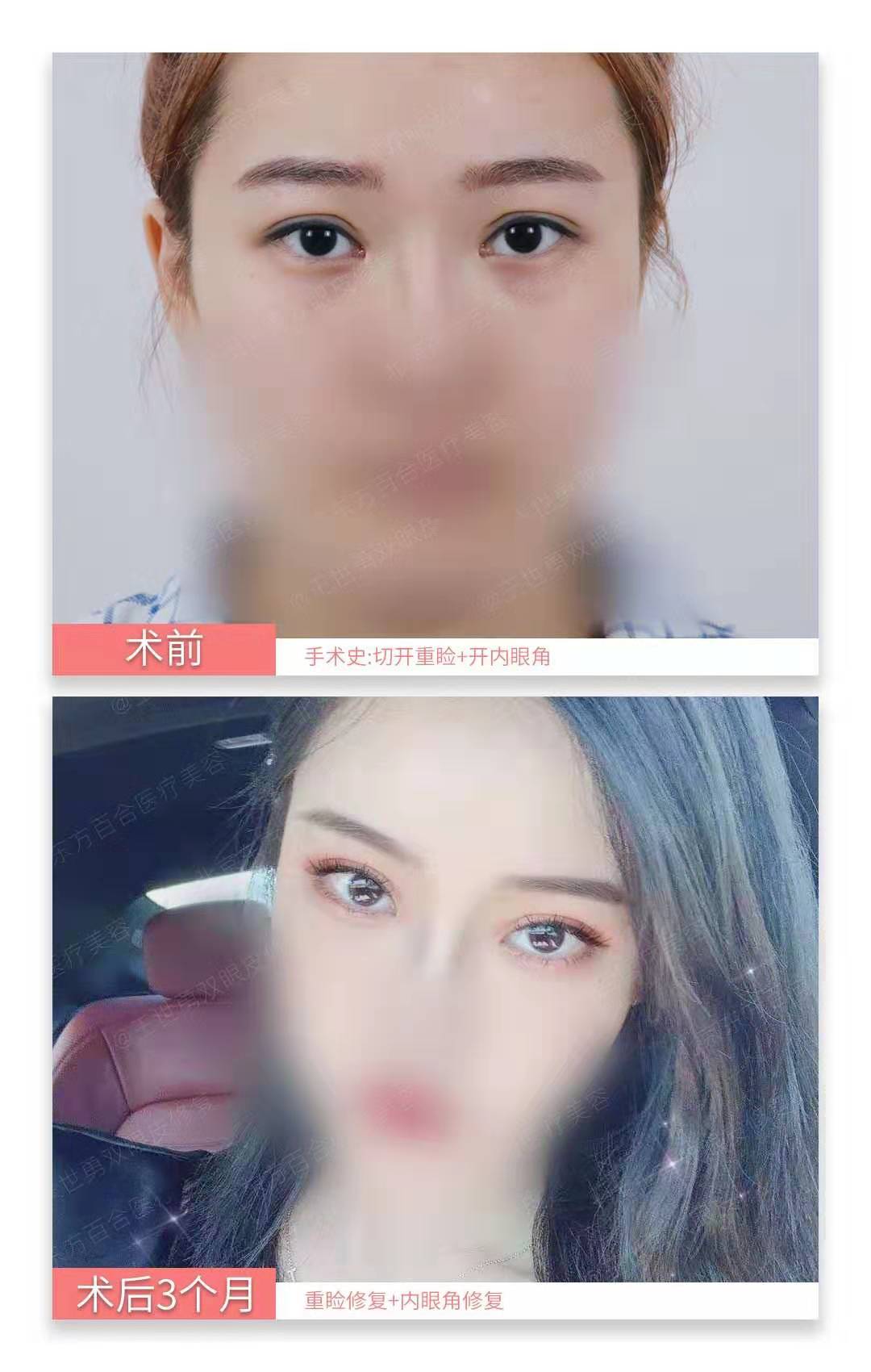北京高难度内眼角修复专家都有哪些？