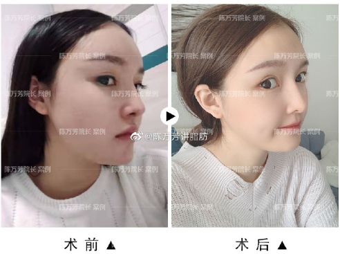 陈万芳和王明利哪个做吸脂修复好
