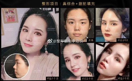 李劲良和李信锋哪个隆鼻好