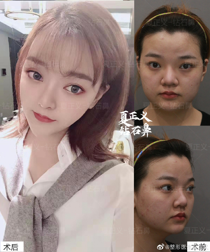 夏正义做鼻子和鼻修复技术好吗？夏正义简介预约案例