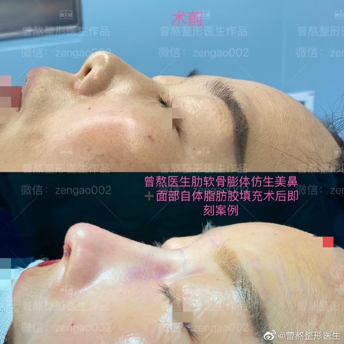 西安曾熬隆鼻技术靠谱吗？曾熬口碑好吗？