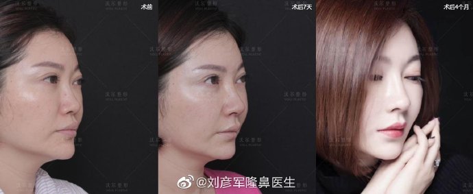 全国隆鼻最有名的医生是谁，收费贵不贵？