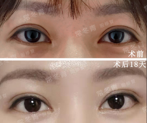 眼修复医生常冬青技术怎么样