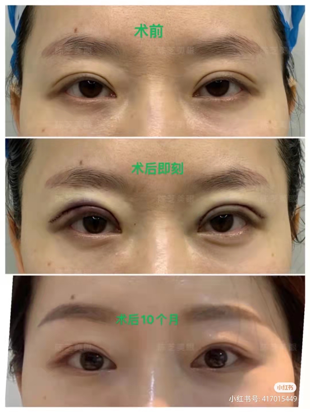 深圳眼修复医生陈芝技术怎么样？