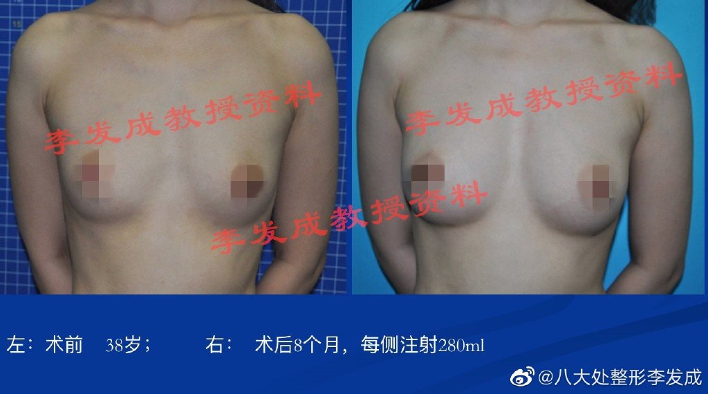  八大处脂肪隆胸哪个医生好？