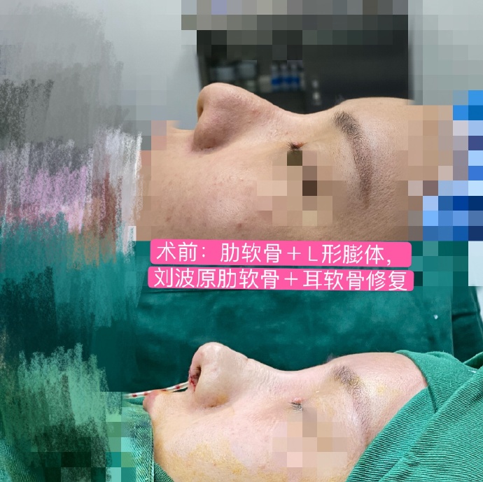 刘波和王会勇哪个做鼻子好