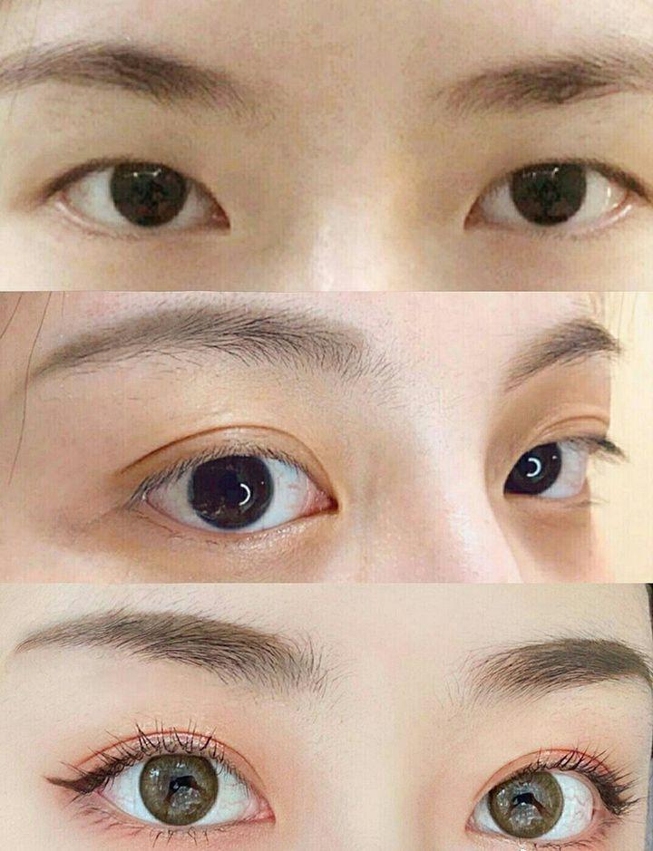 北京吴宇宏双眼皮做得好吗