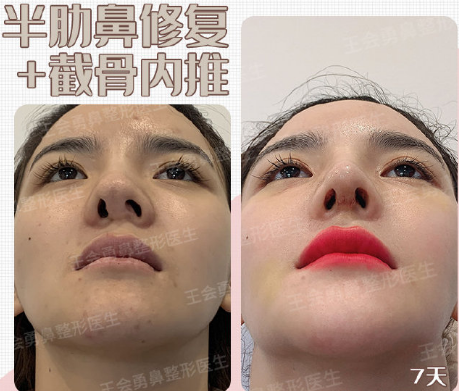 上海鼻修复专家最厉害和权威的是谁