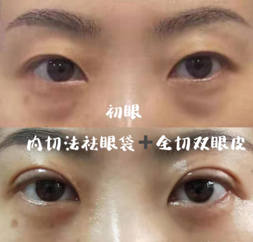 南京刘宁和刘育凤去眼袋手术哪个技术好？