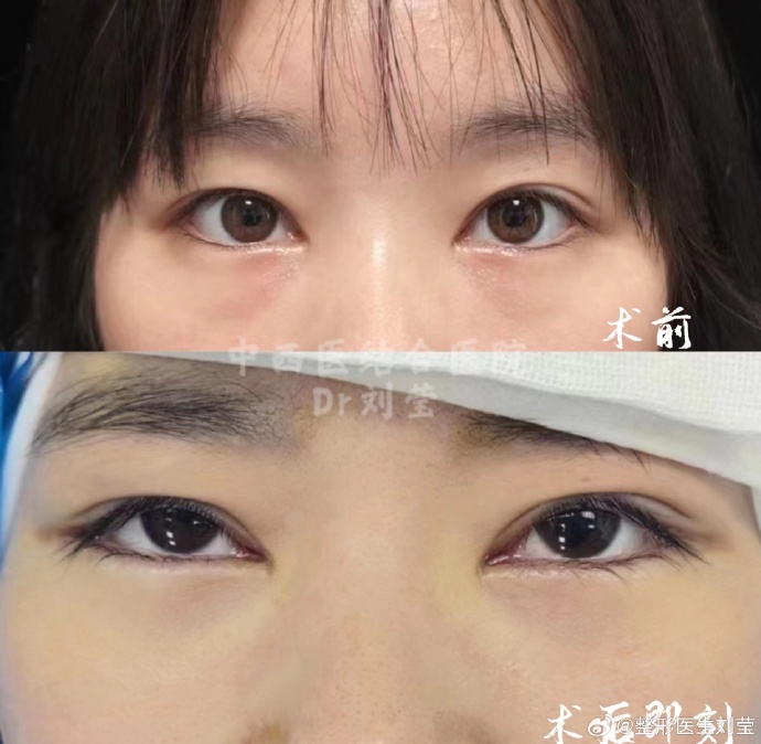 北京刘莹医生祛眼袋技术怎么样？刘莹祛眼袋预约咨询电话