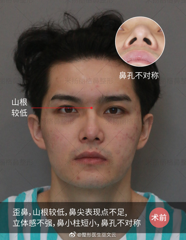 北京鼻修复专家巫文云和李劲良哪个好？
