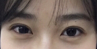 上海九院割双眼皮最好的医生