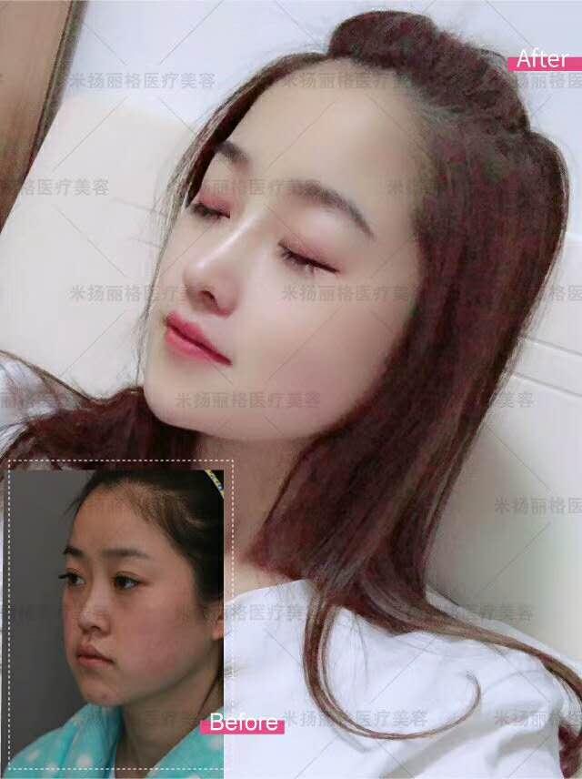 北京做肋软骨隆鼻的医生谁最好？巫文云和刘彦军哪个好？