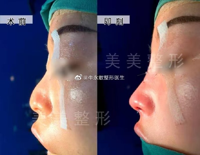 牛永敢与欧阳春谁鼻修复更好
