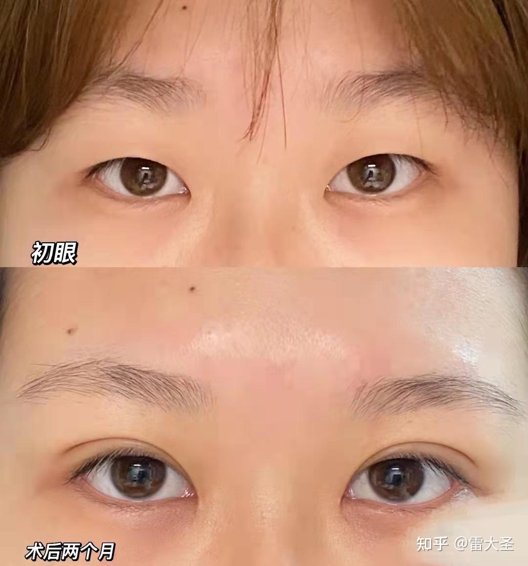 上海九院罗旭松做双眼皮怎么样？罗旭松做眼修复技术好吗？